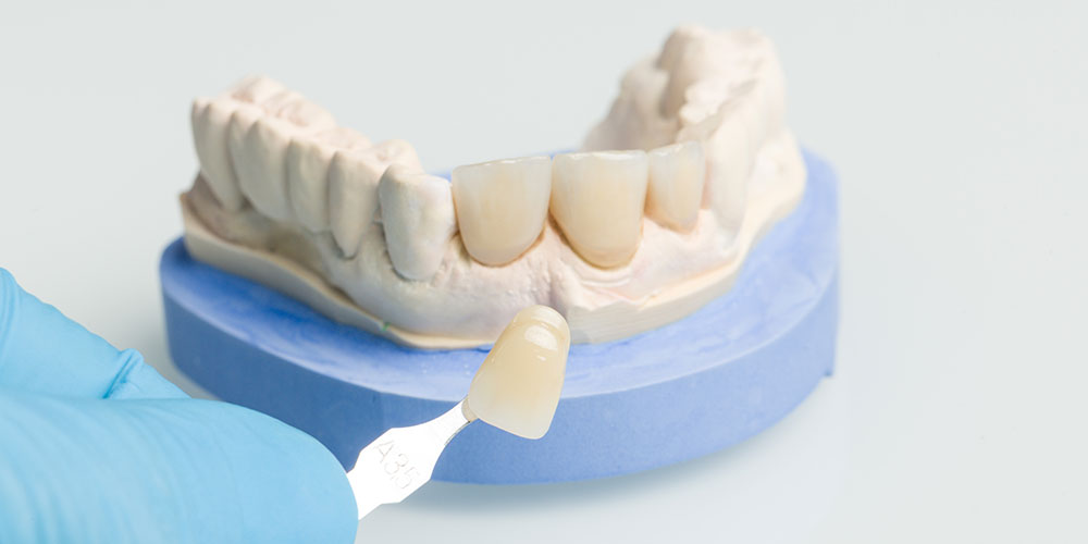 Read more about the article Existe Faceta de Porcelana ou Lente de Contato Dental na parte detrás do dente?